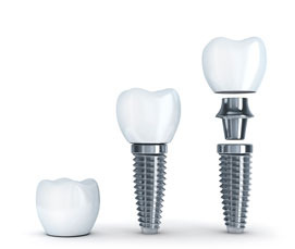 Имплантация